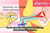 Clip cận cảnh bơm tinh trùng vào buồng tử cung Clip cận cảnh bơm tinh trùng vào buồng tử cung